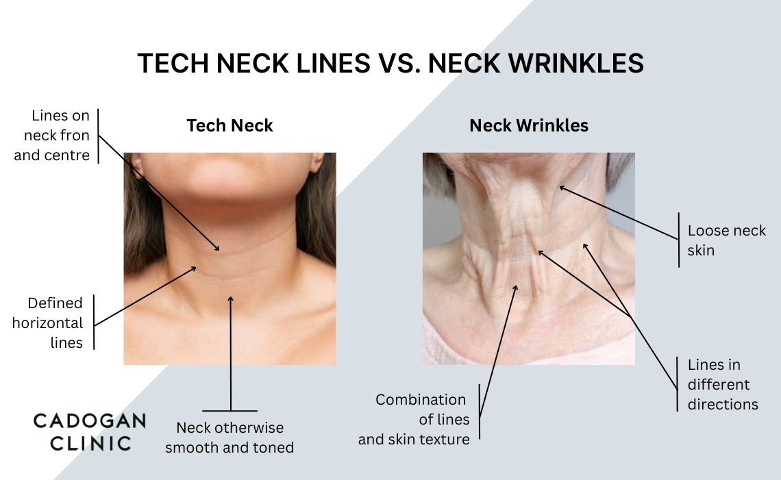 Infographic showing the differences between a neck affected by tech neck, and a neck affected by the common signs of ageing